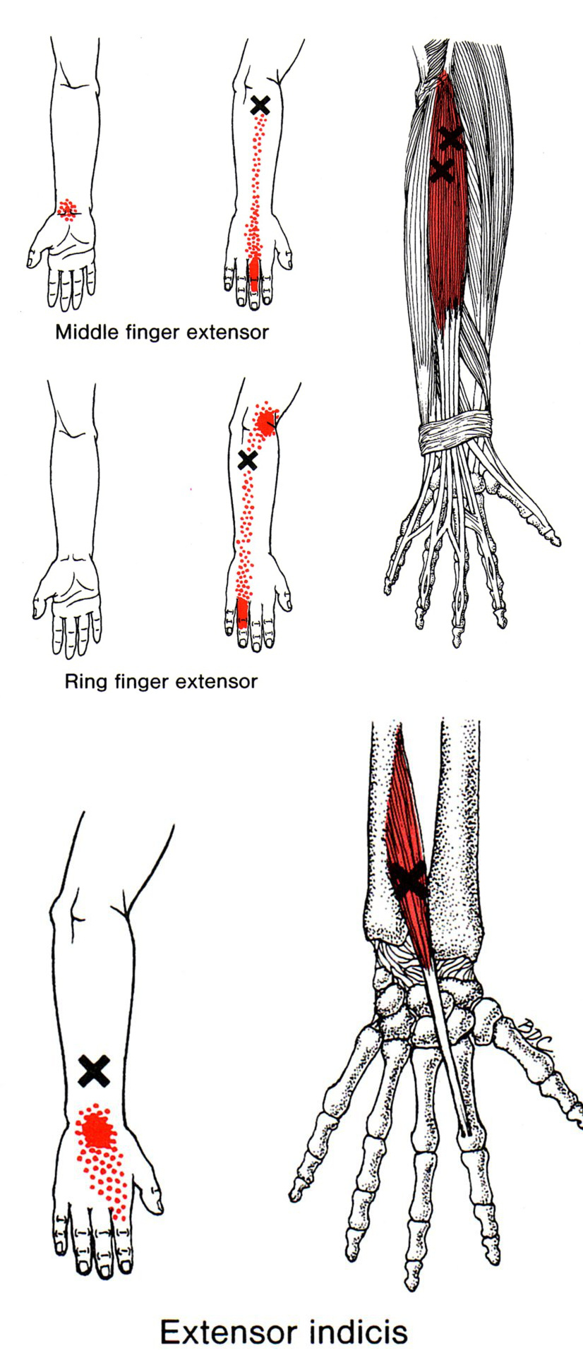 Extensor Digitorum The Trigger Point & Referred Pain Guide